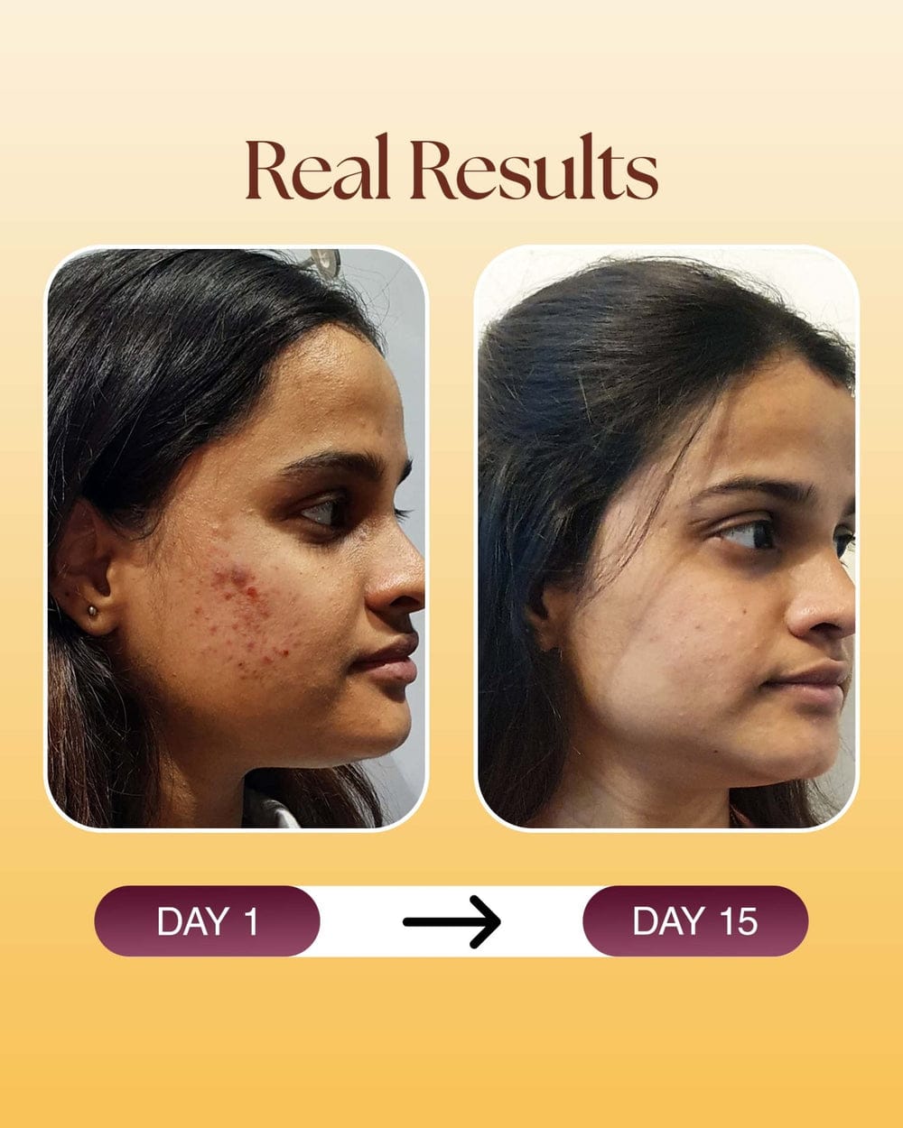 Psoris Capsules by Kavyas Ayurveda – Ayurvedic Internal Support for Psoriasis, Eczema & Skin Detox (30 Capsules)